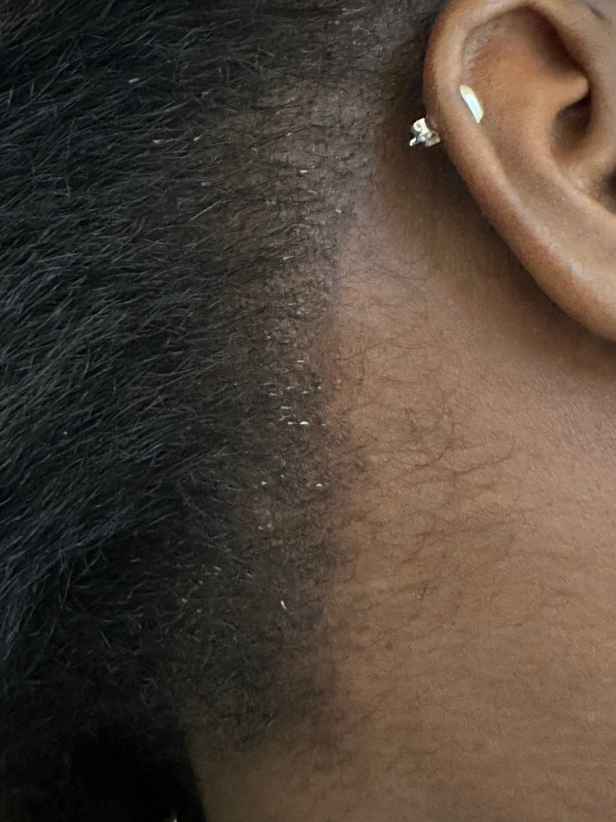 Alopecia: Understanding Hair Loss Without Panic